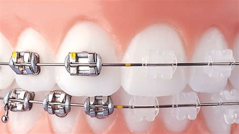 brackets esteticos vs metalicos|brackets de cerámica.